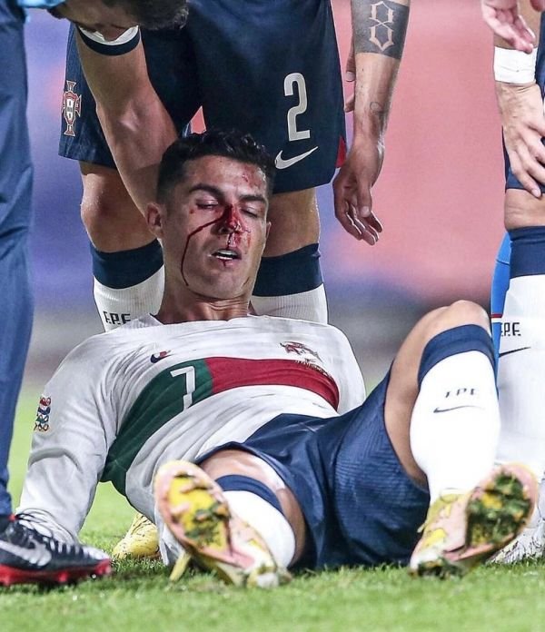 رونالدو يتعرض لإصابة شديدة خلال مباراة البرتغال والتشيك