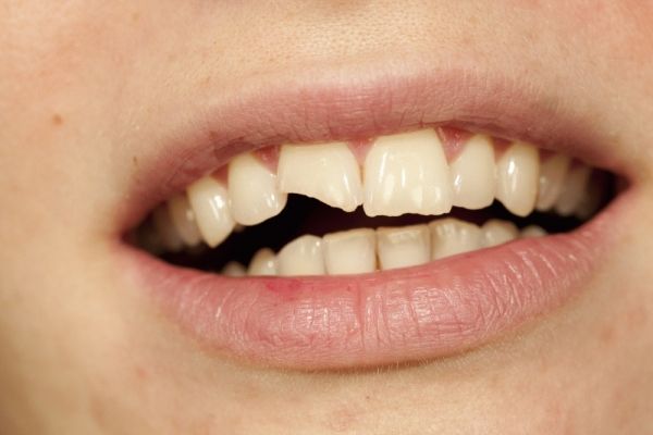 ماذا تقول "أسنانك" عن المخاطر الصحية التي تواجهك؟ - صحيفة الجامعة