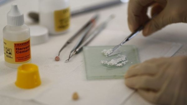 في حالة نادرة.. أطباء يقتلعون 526 سنا من فم طفل (فيديو) - صحيفة الجامعة